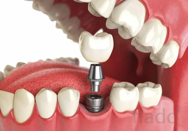 Импланты зубов Все на 4 имплантах.