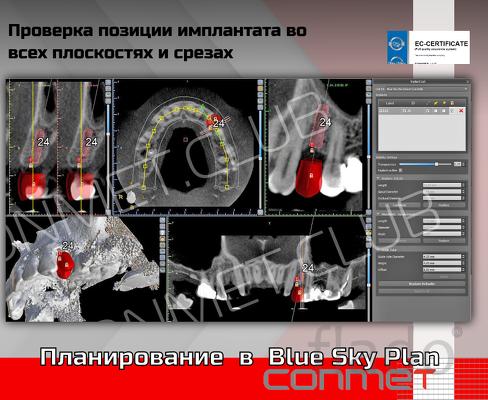 Планирование в Blue Sky Plan - соблюдение зоны безопастности до анатом