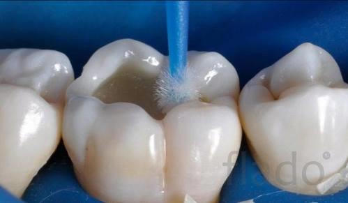 Восстановление стершихся зубов