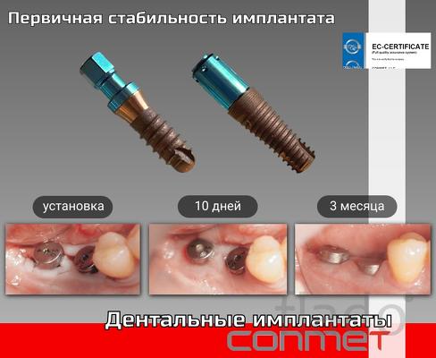 Первичная стабильность дентального имплантата КОНМЕТ