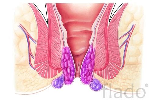Лечение острого геморроя