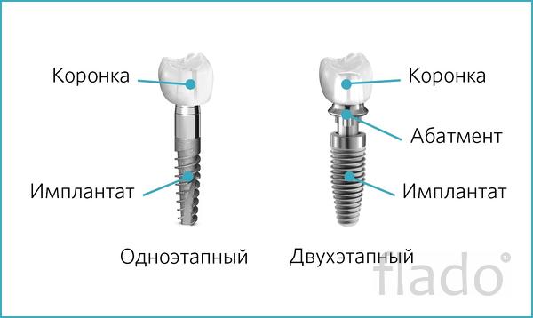 Имплантация зубов