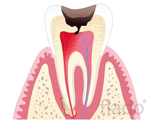 Лечение периодонтита