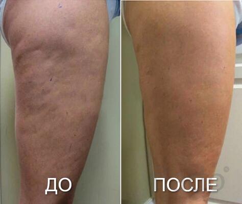 Массаж Классический, Антицеллюлитный, Огненный