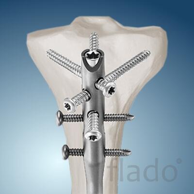 Интрамедуллярный остеосинтез