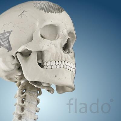 Краниопластика