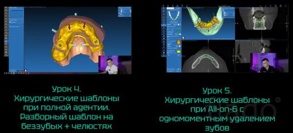 Цифровой курс по хирургическим конструкциям в программе RealGuide