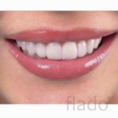 Керамические виниры высочайшего качества в Екатеринбурге