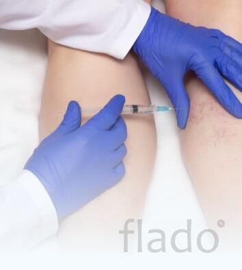 Склеротерапия вен