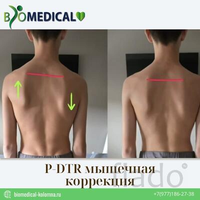 P-DTR мышечная коррекция