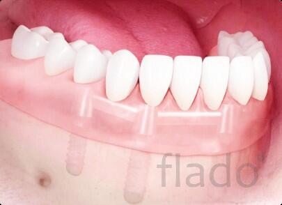 Несъемные протезы в Москве