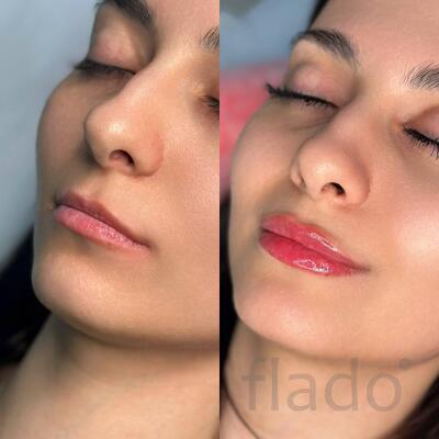 Увеличение губ в Медведково (Juvederm Ultra Smile 0,55 мл)