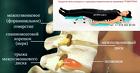 Лечение компрессионного перелома позвоночника - тренажер Грэвитрин