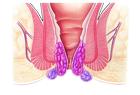 Лечение острого геморроя