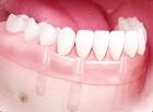 Несъемные протезы в Москве
