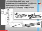 Ортодонтический винт для вспомогательной опоры установка в ретромоляр